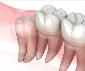 wisdom teeth